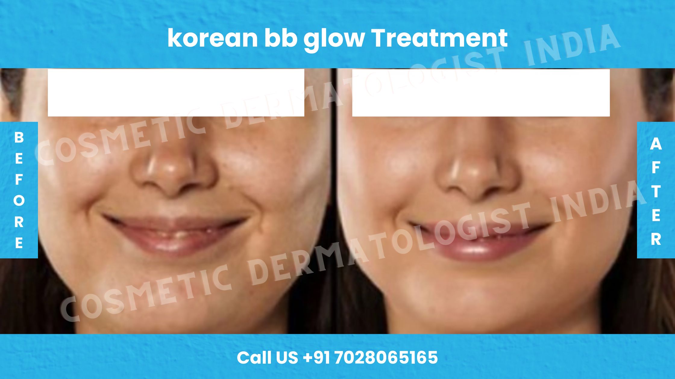 Before and After images of Korean BB Glow Treatment