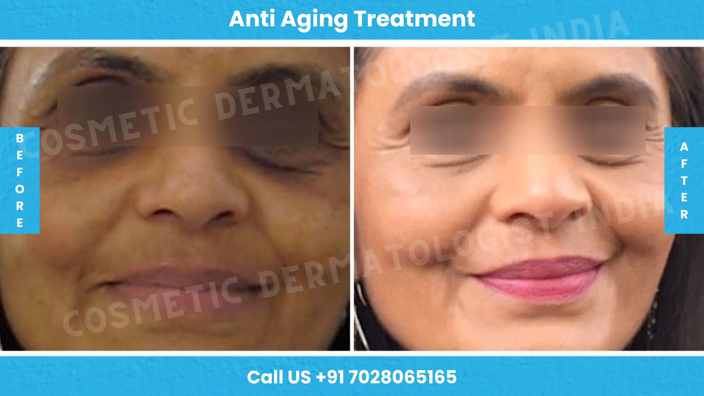 Before and After Images of Anti Aging Treatment