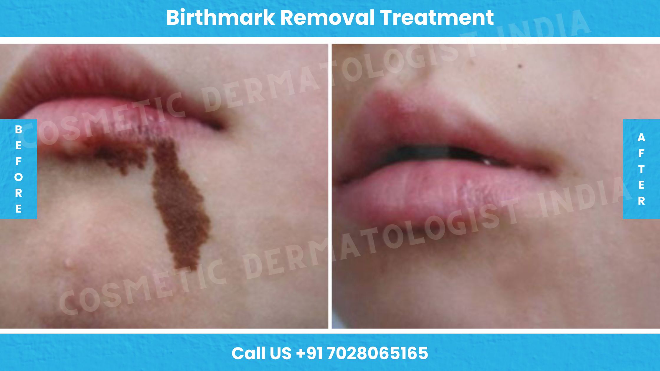 Before and After Images of Birthmark Removal Treatment