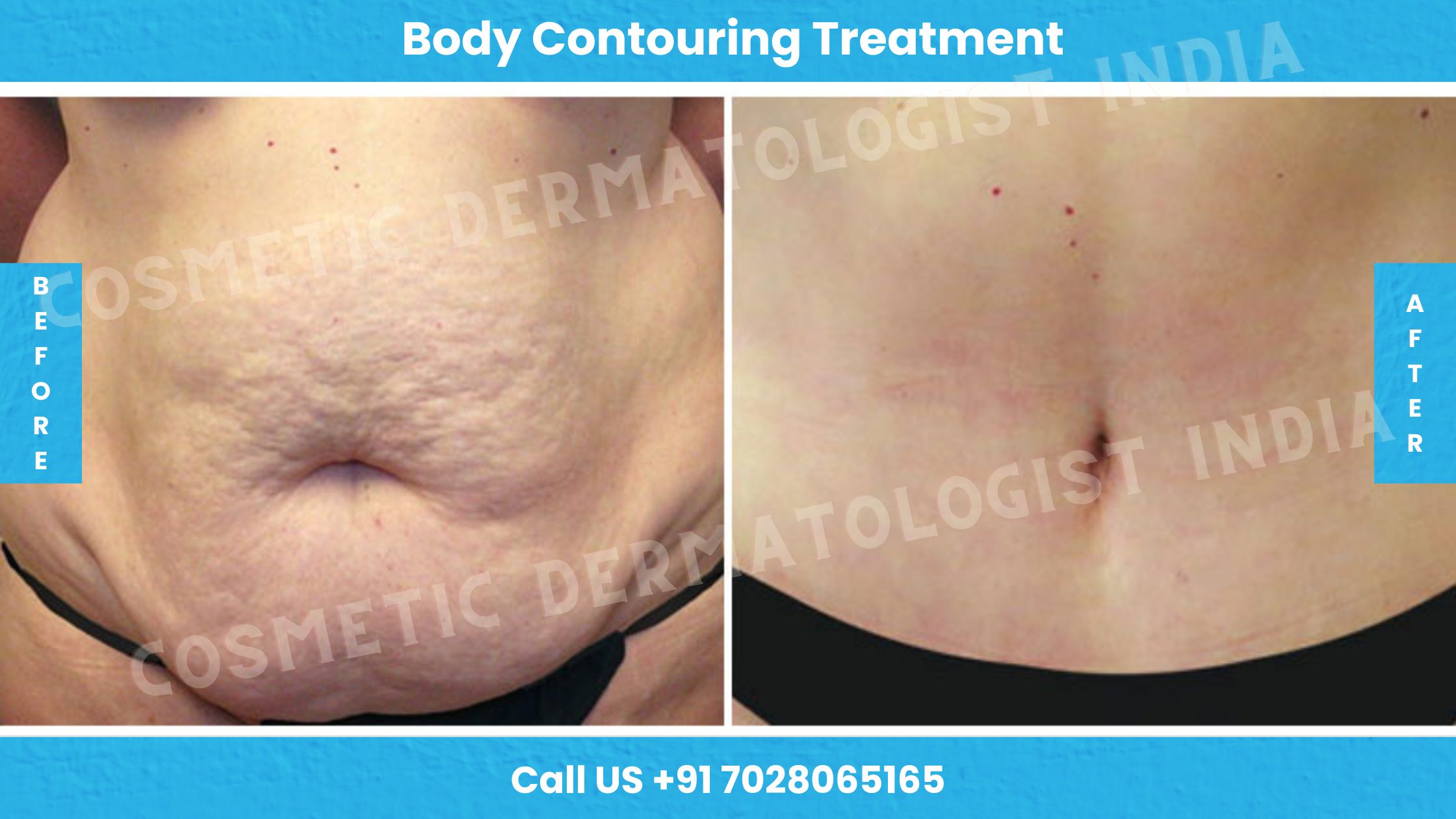 Before and After Images of Body Contouring Treatment