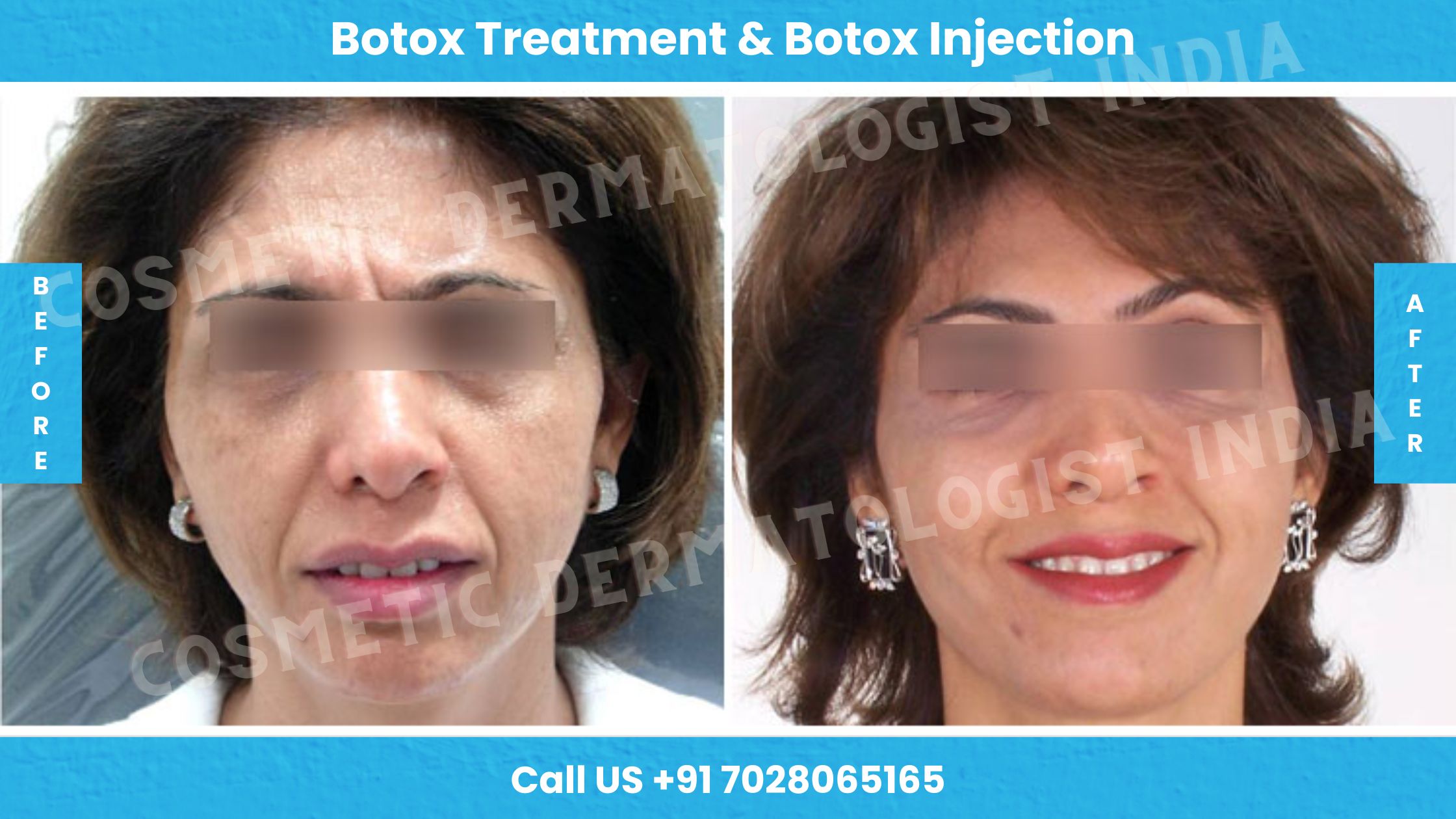 Before and After Images of Botox Treatment & Botox Injection