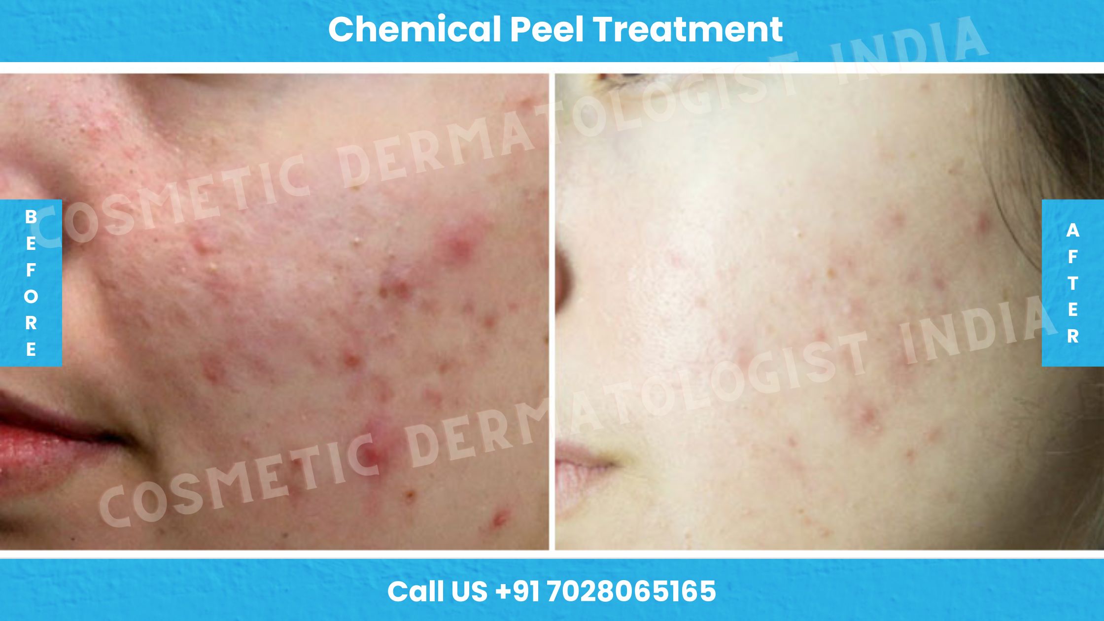 Before and After Images of Chemical Peel Treatment