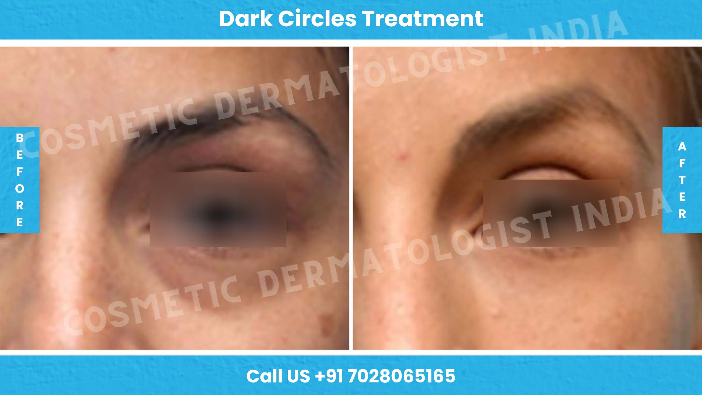Before and After Images of Dark Circles Treatment