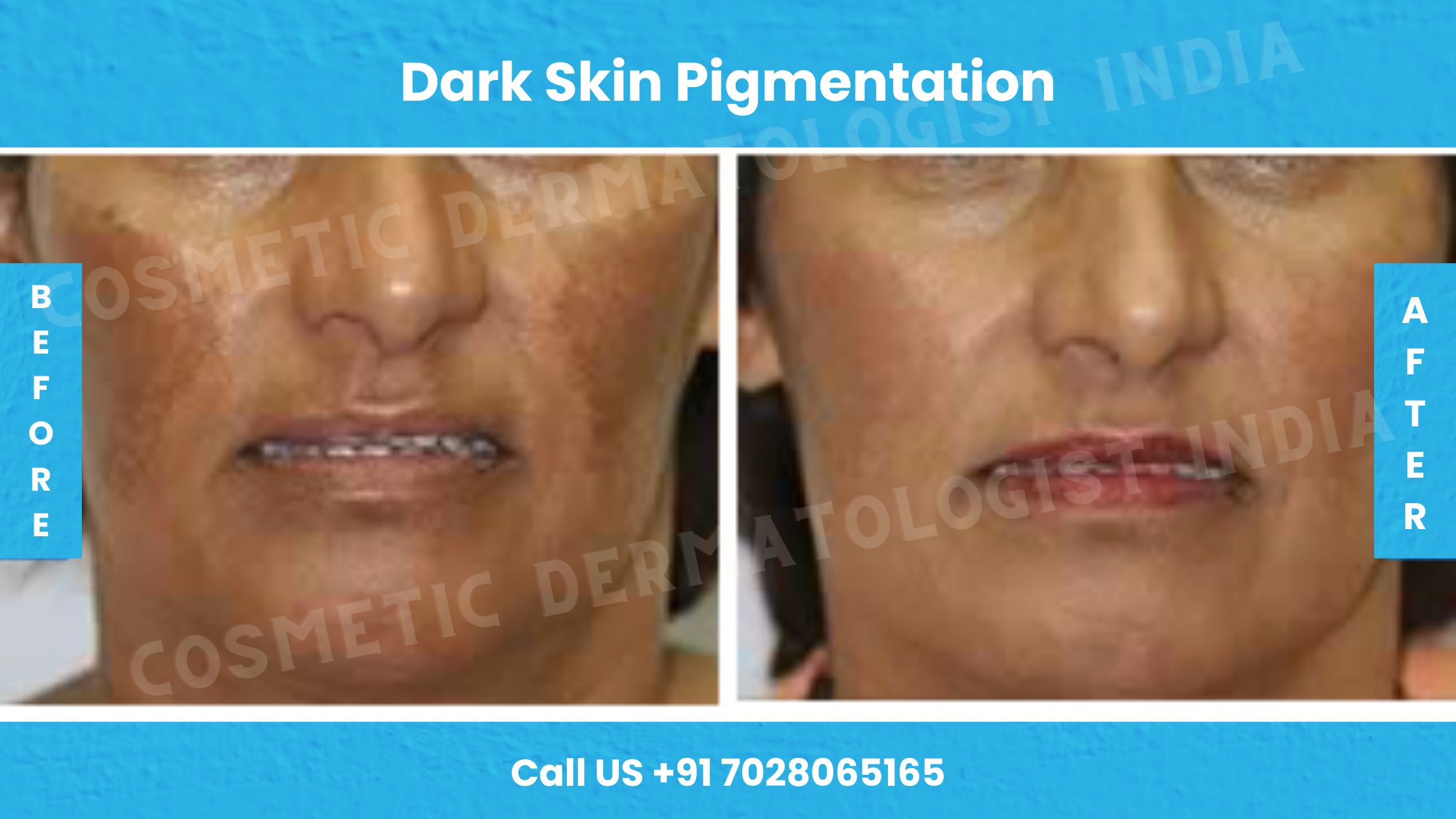 Before and After Images of Dark Skin Pigmentation