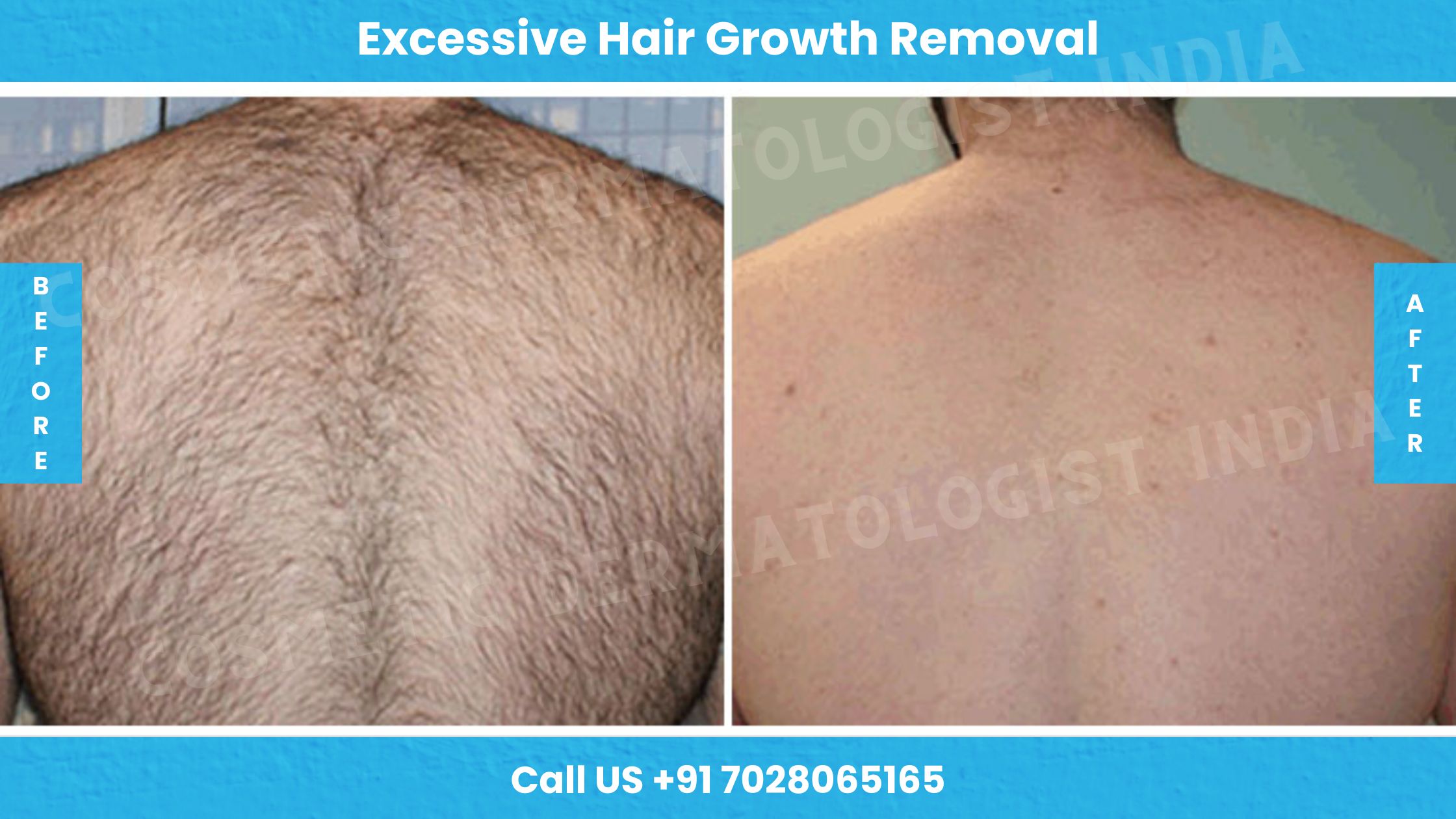 Before and After images of Excessive Hair Growth Removal Treatment