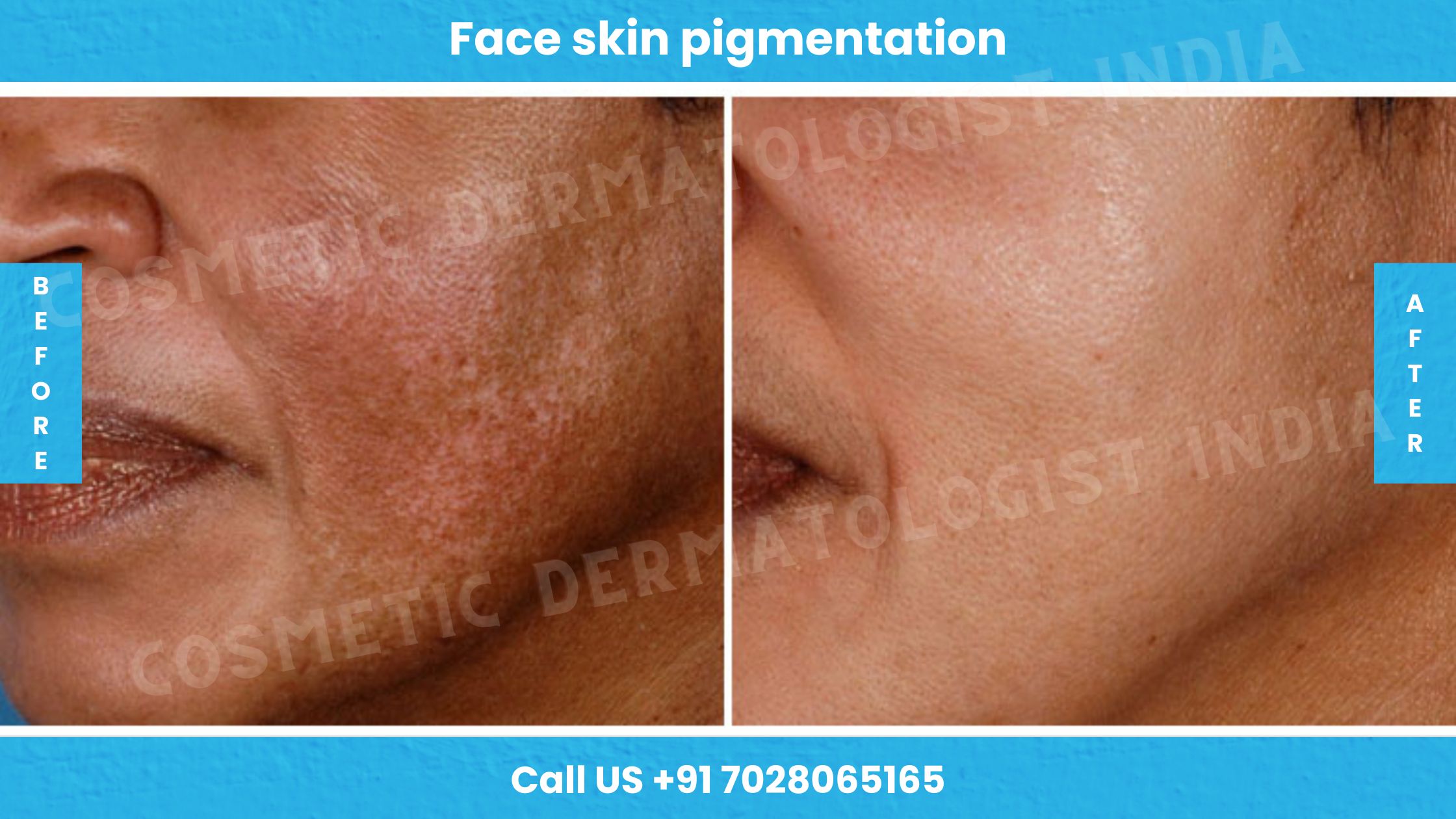 Before and After images of Face Skin Pigmentation