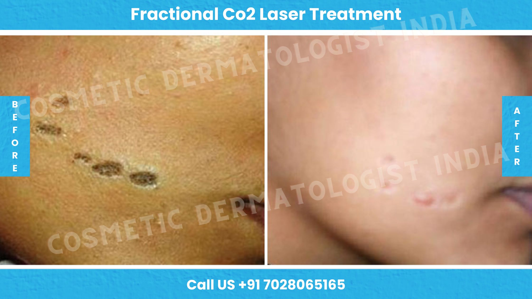 Before and After Images of Fractional CO2 Laser Treatment 