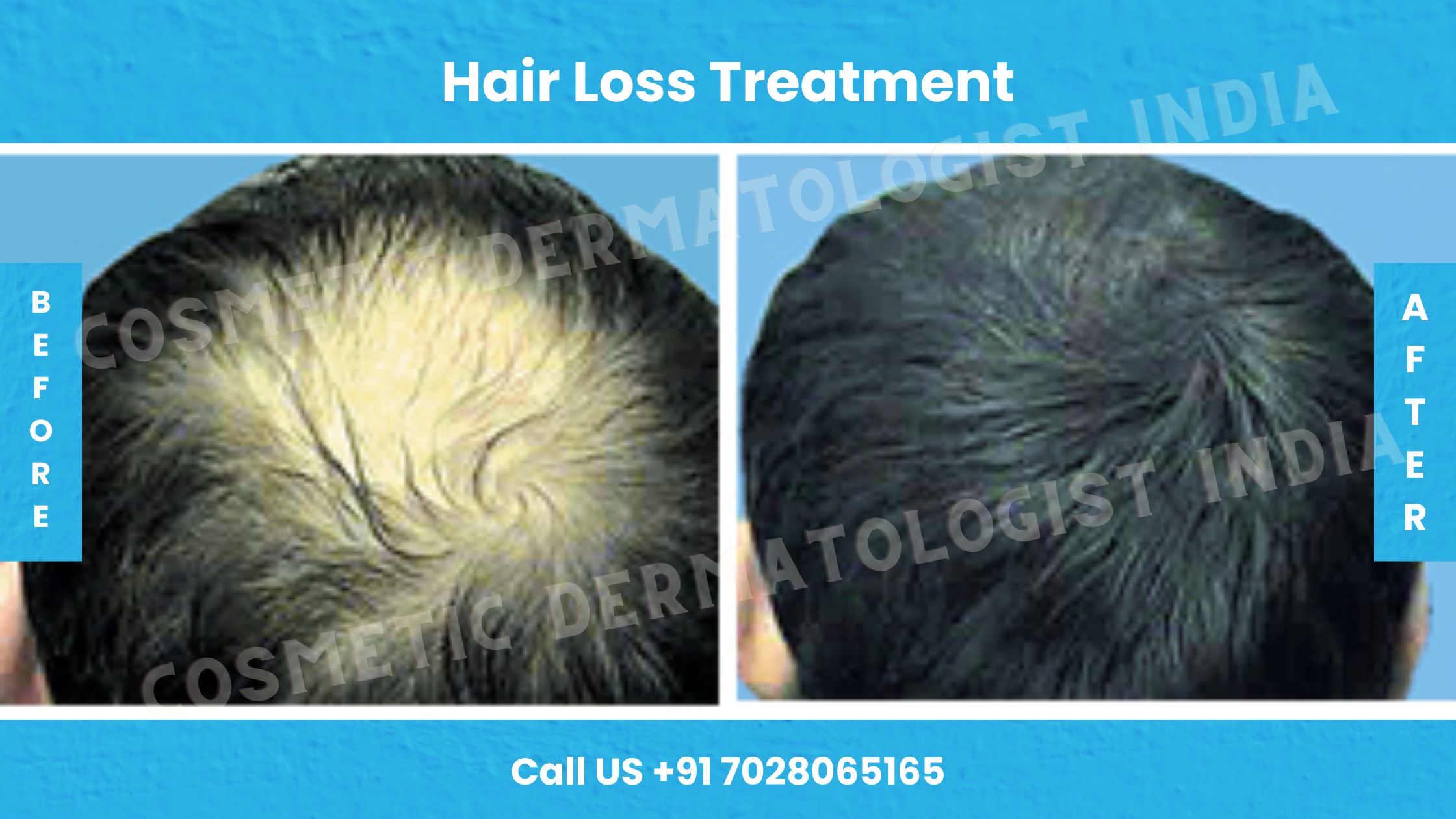 Before & After  Images of Hair Loss Treatment