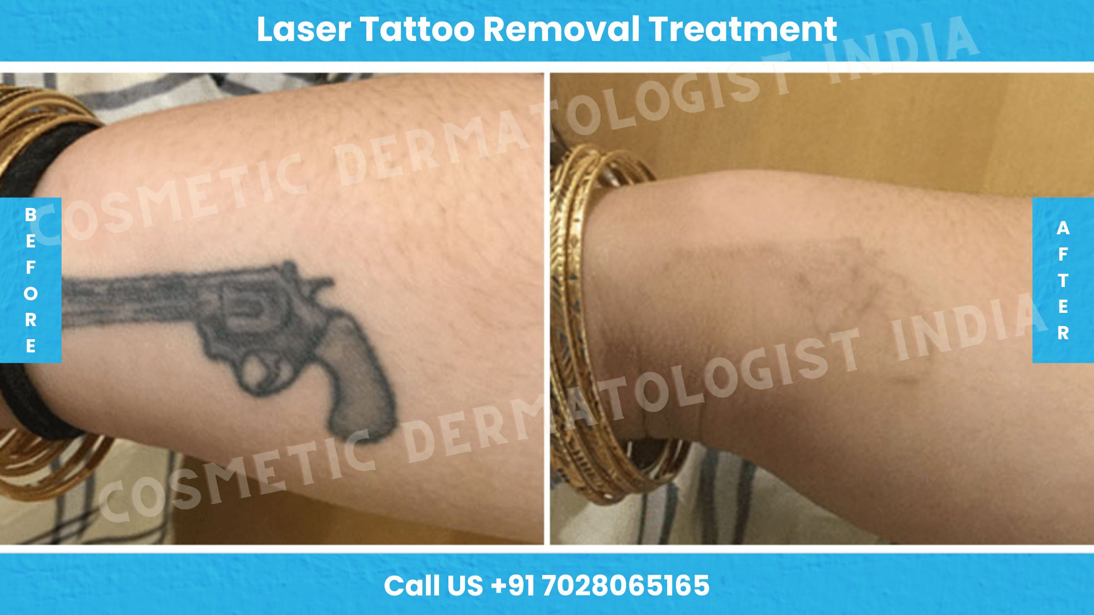 Before and After Images of Laser Tattoo Removal Treatment