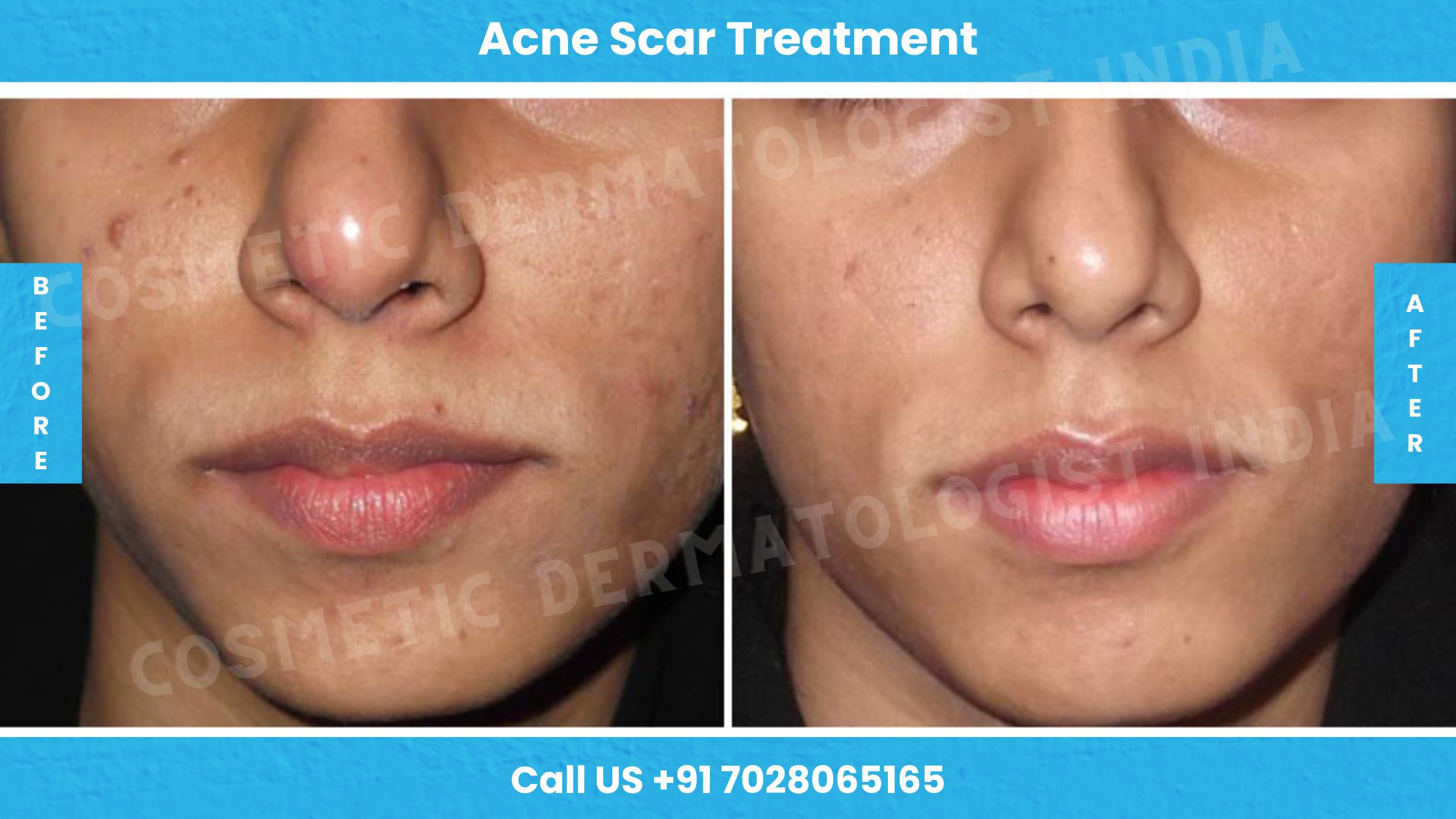 Before and after images of Acne Treatment