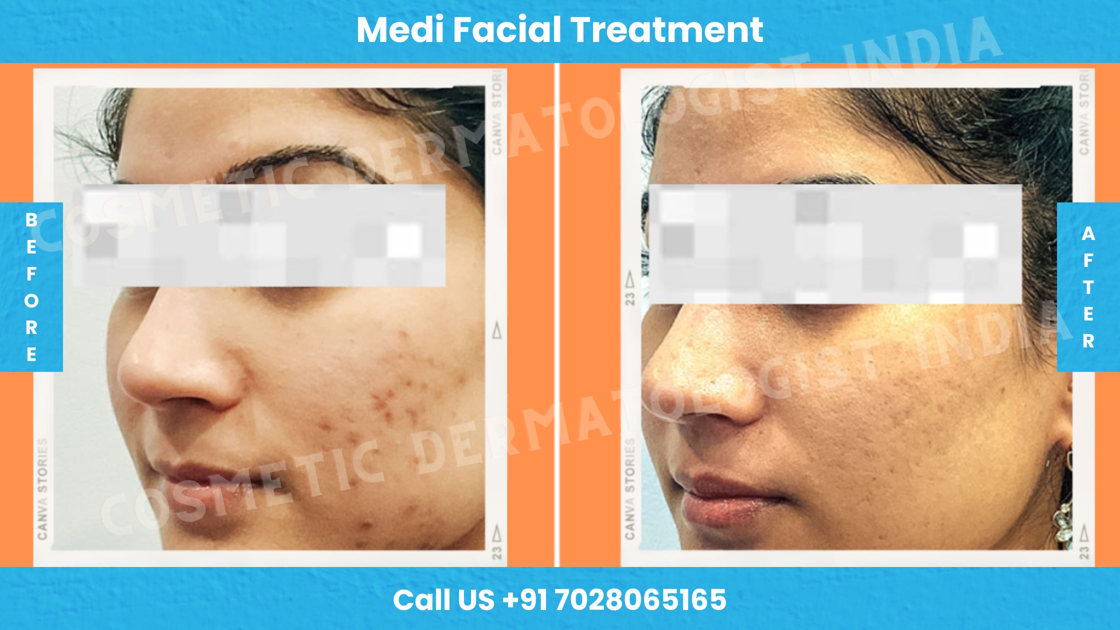 Before and After Images of Medi-Facial Treatment