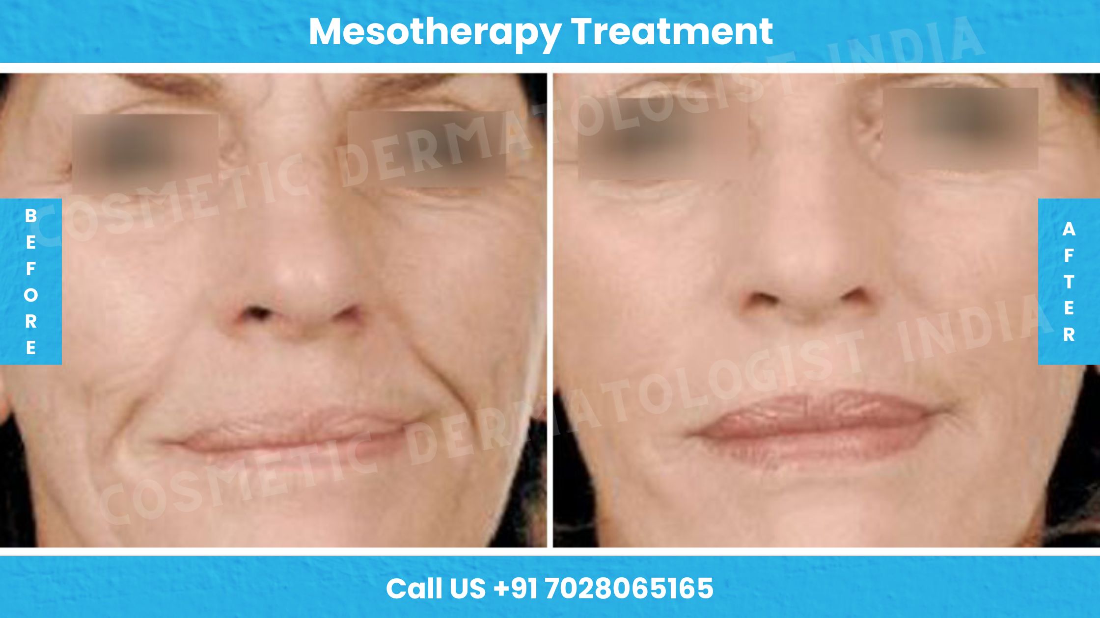Before and After Images of Mesotherapy Treatment 