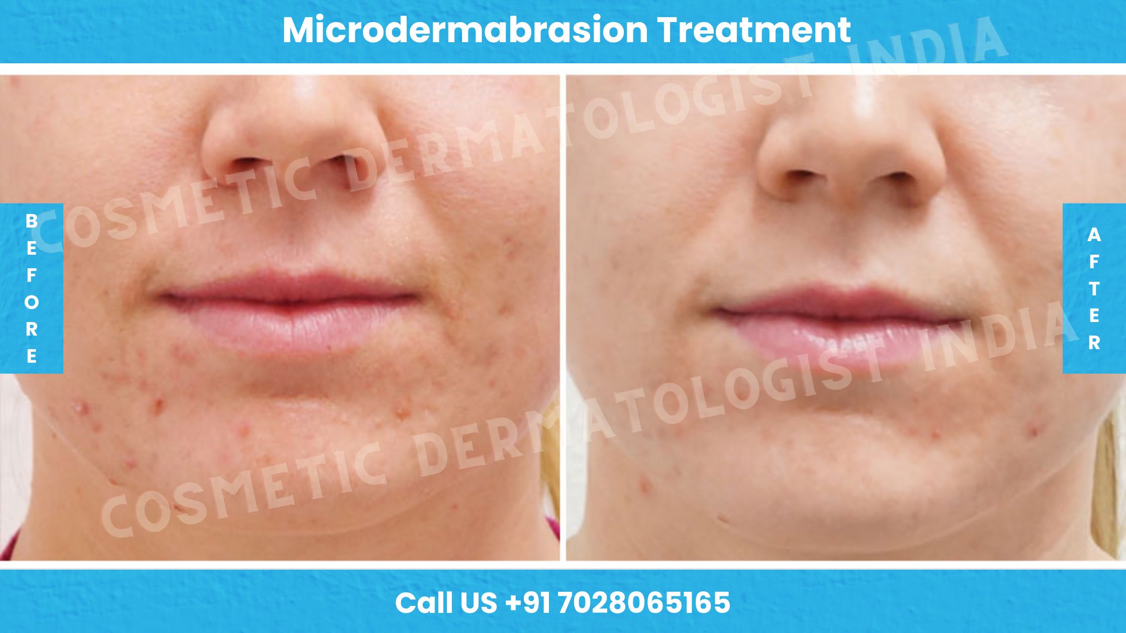 Before and After Images of Microdermabrasion Treatment 