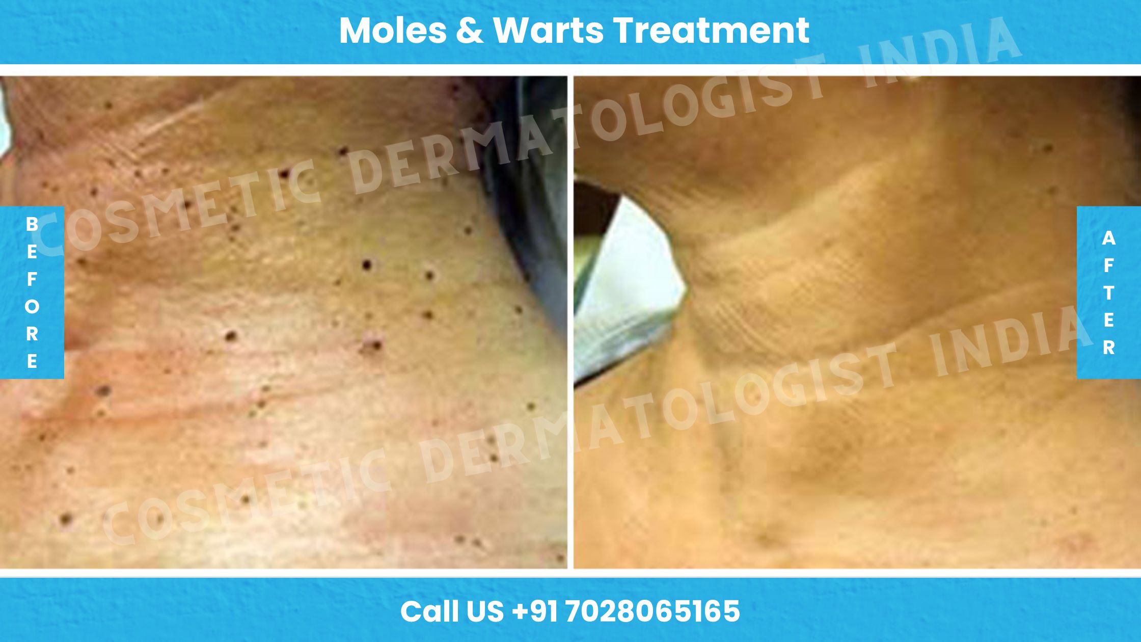 Before and After Images of Moles and Warts Treatment