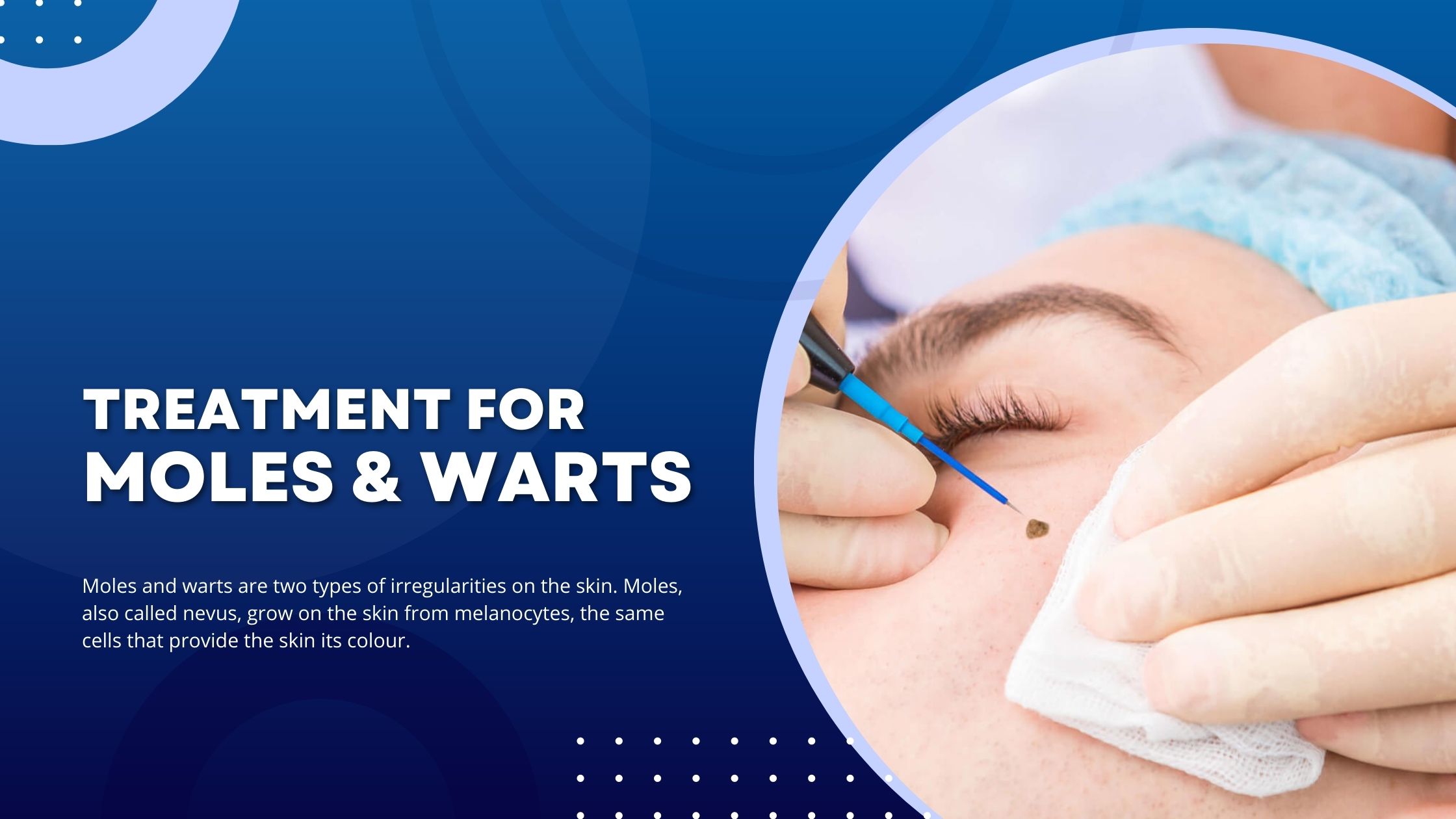 Warts & Moles Treatment
