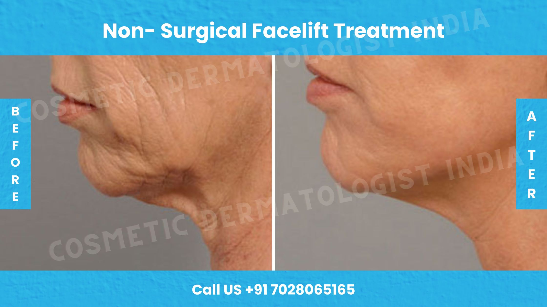 Before and After Images of Non- Surgical Facelift Treatment