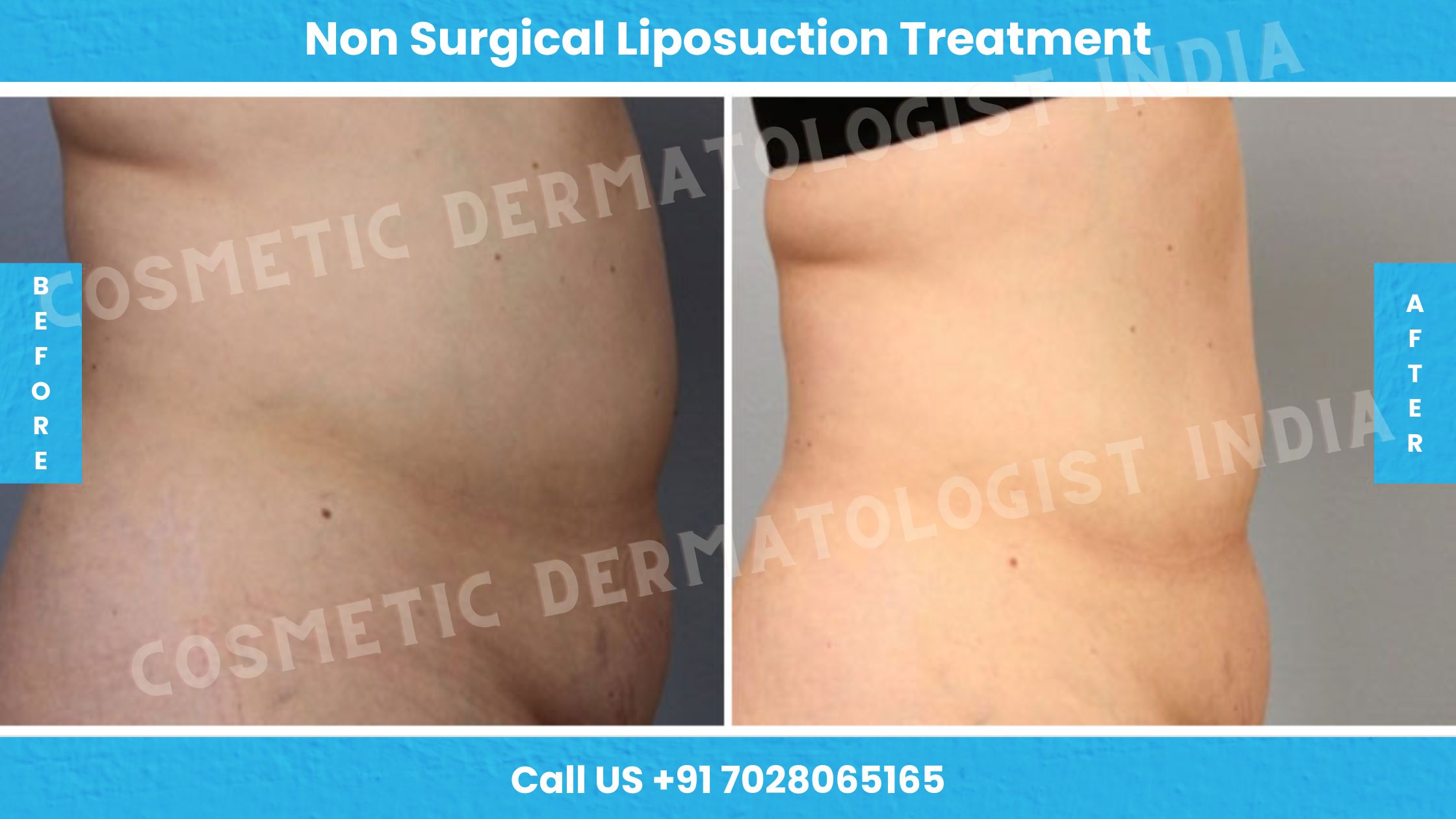 Before and After Images of Non surgical Liposuction Treatment