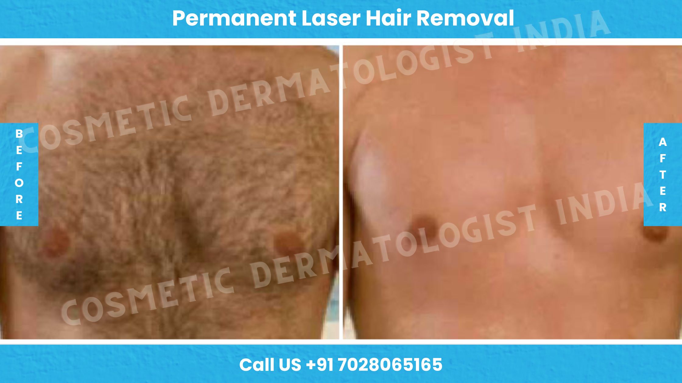 Before and After Images of Permanent Laser Hair Removal Treatment