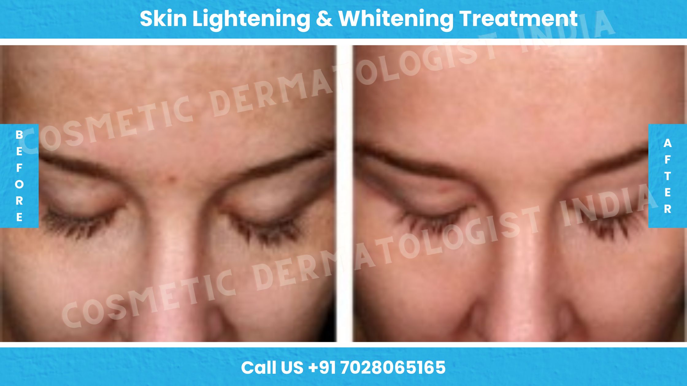 Before and After Images of Laser Skin Lightening and Whitening Treatment