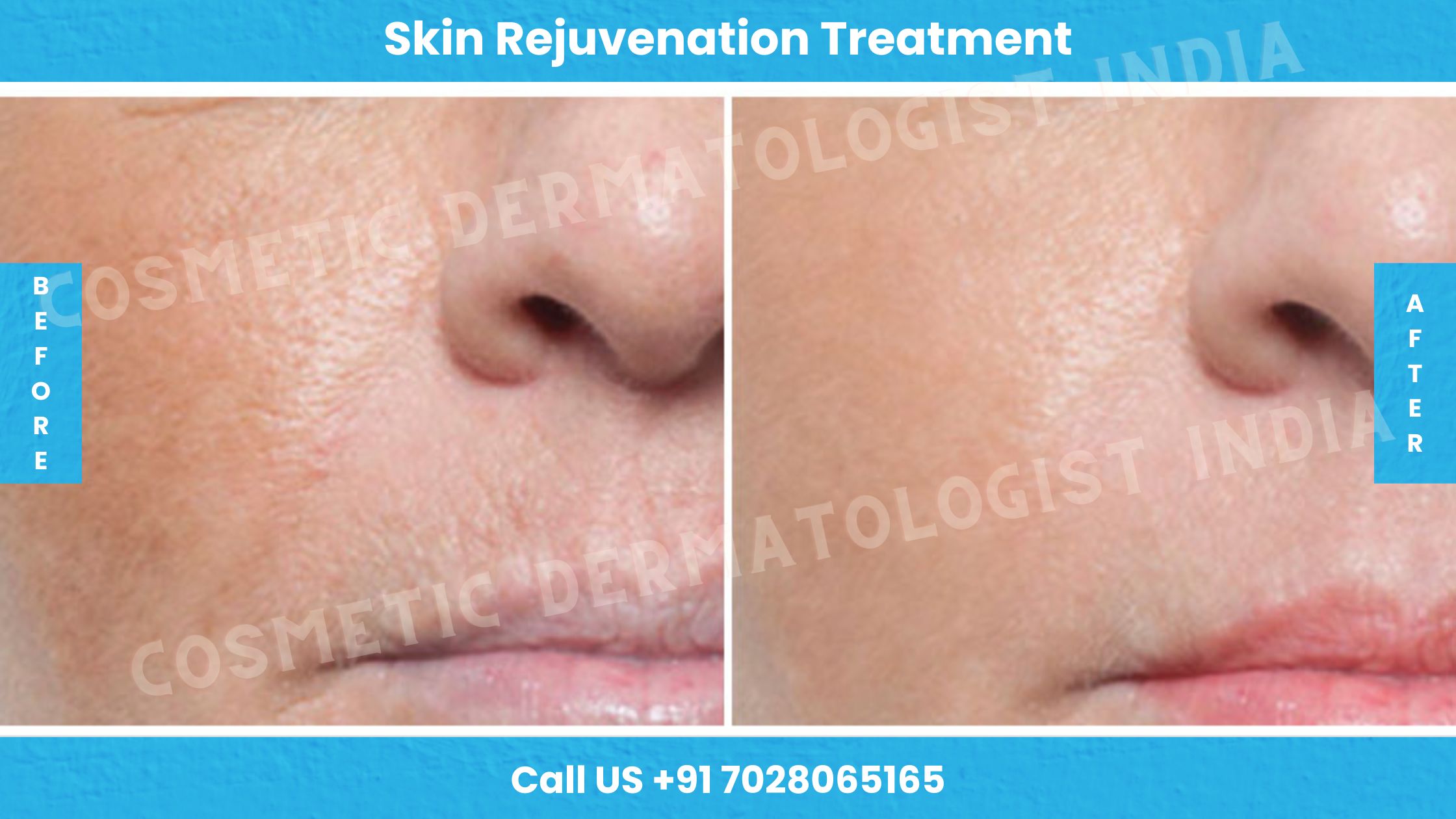 Before and After Images of Skin Rejuvenation Treatment