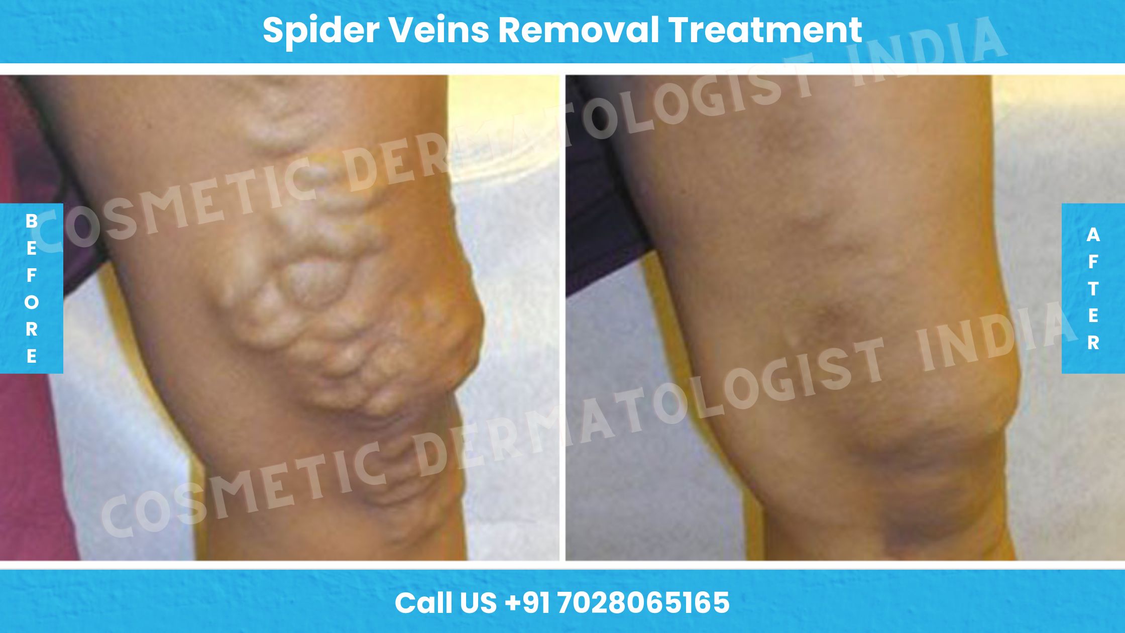 Before and After Images of Spider Veins Removal Treatment