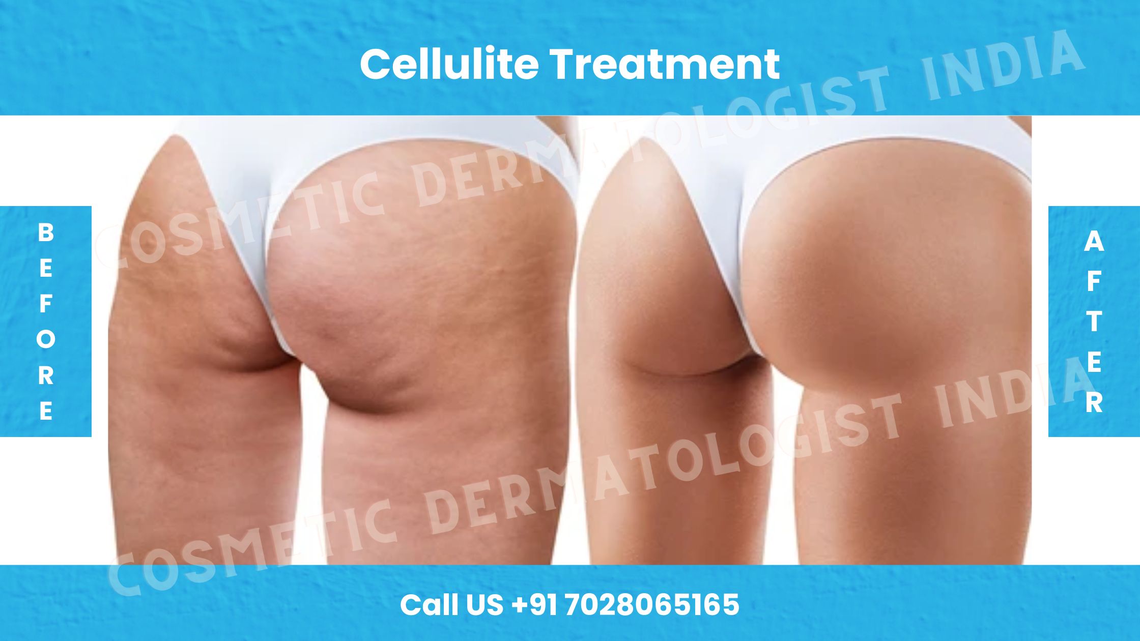 Before and After images of Cellulite treatment