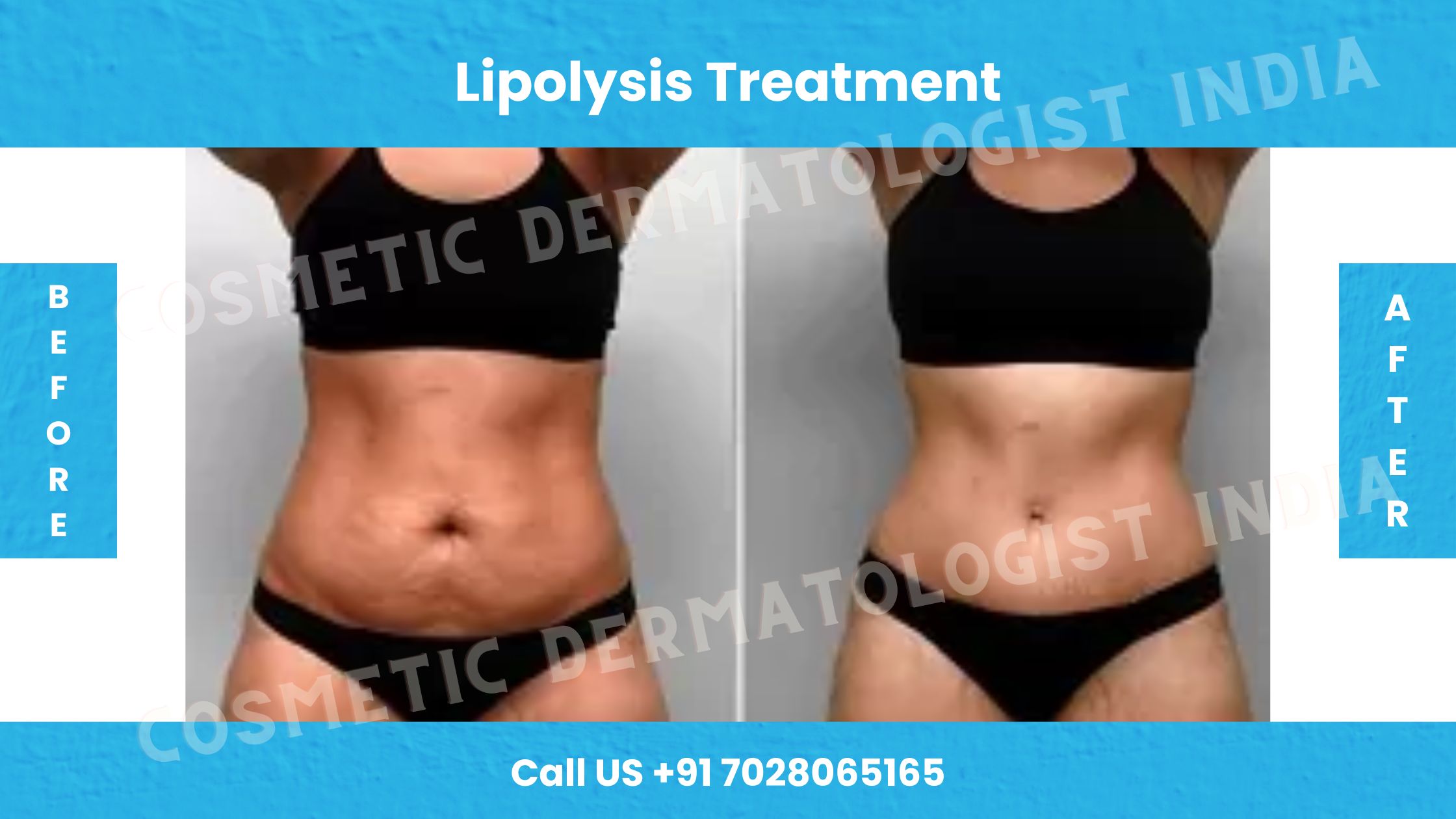 Before and After Photos For Lipolysis Treatment 