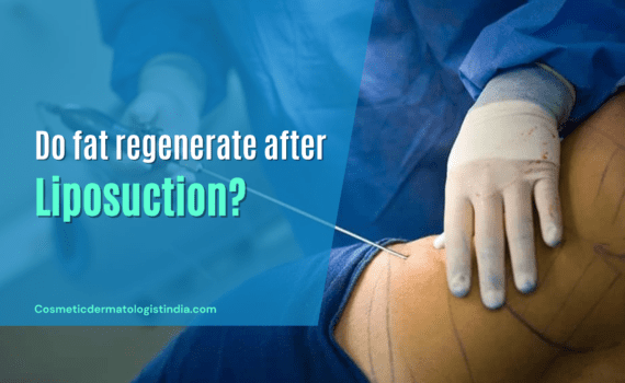 Does fat regenerate after liposuction?