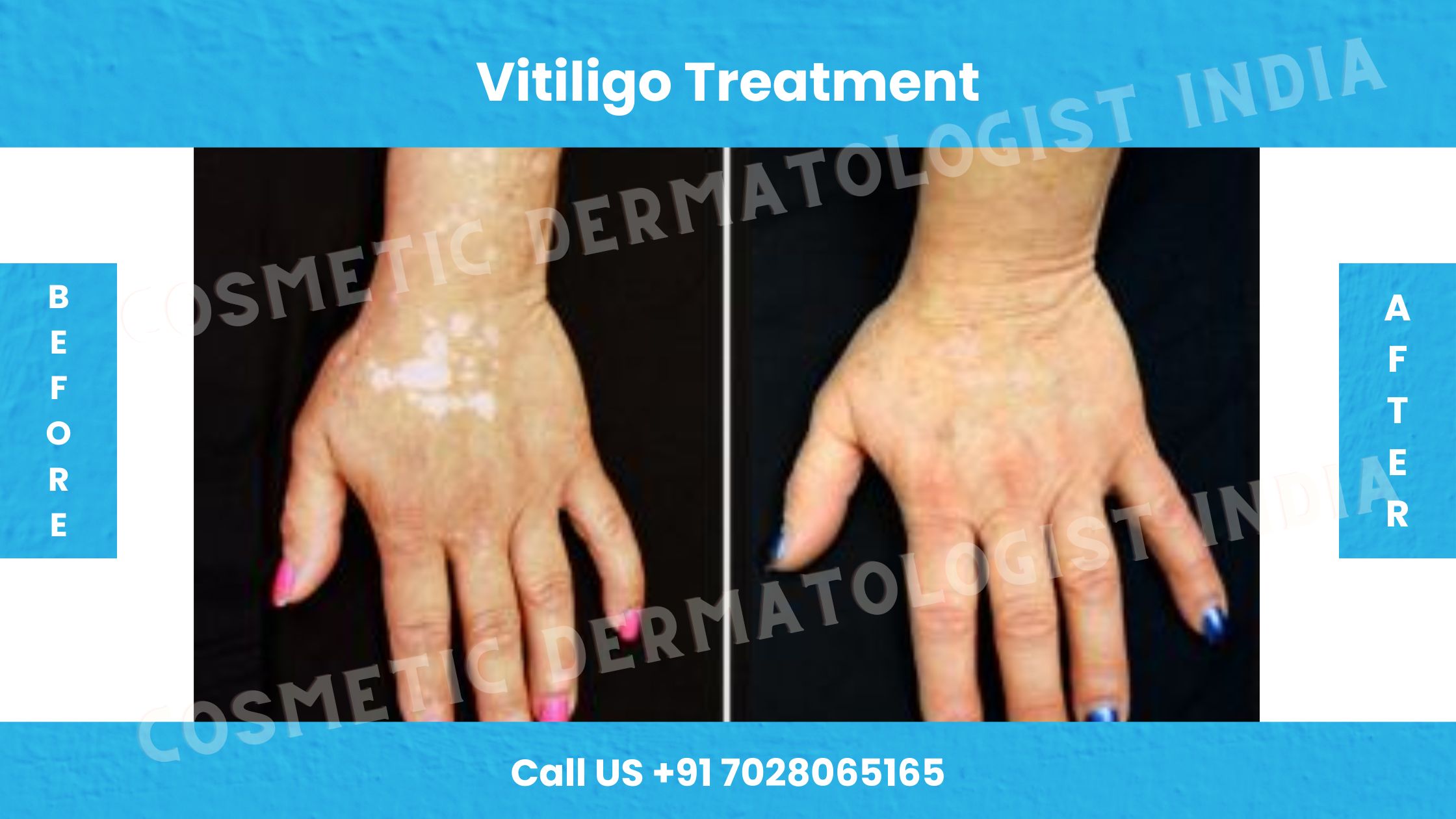 Before and After images of Vitiligo treatment