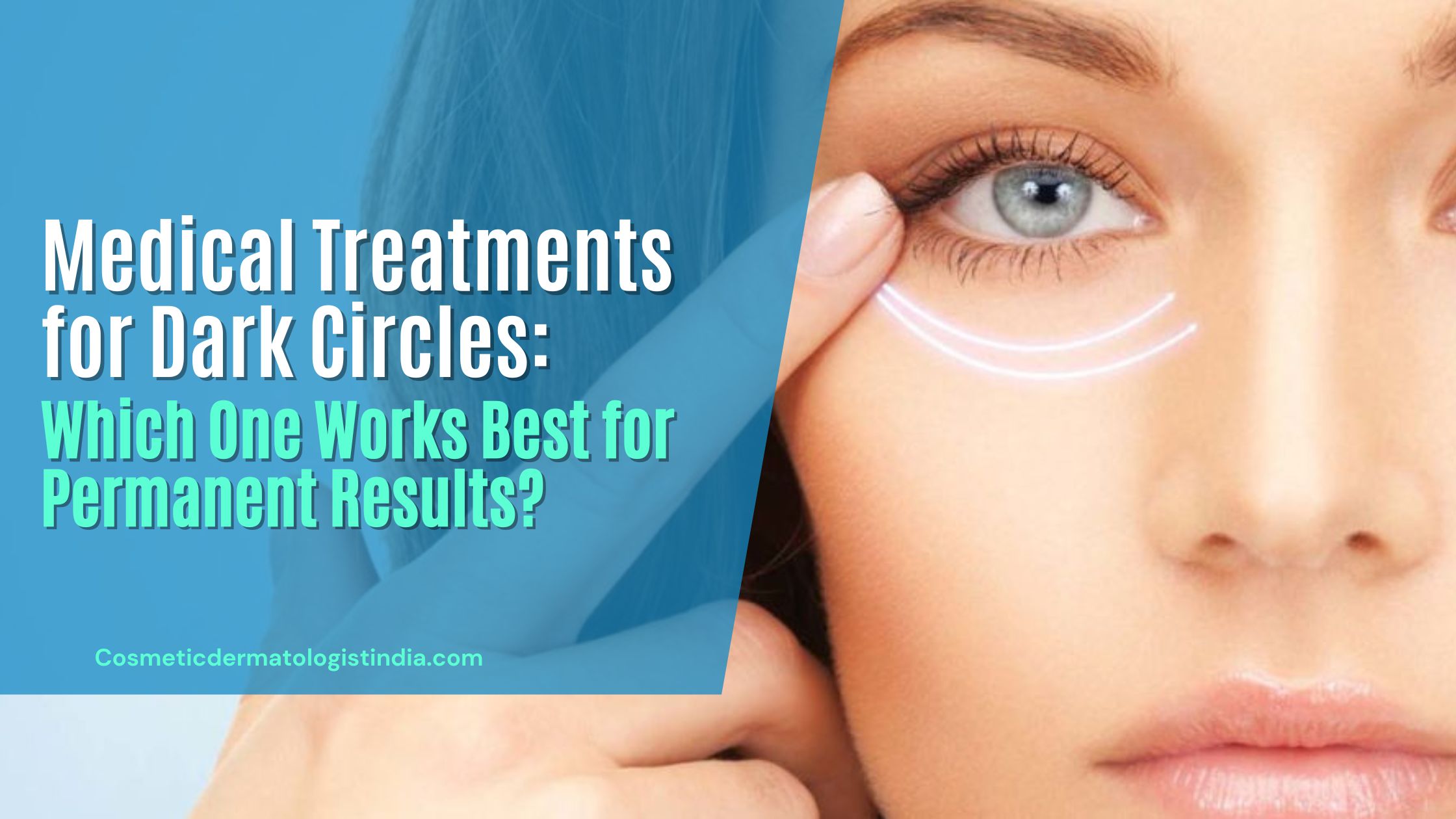 MEDICAL TREATMENTS FOR DARK CIRCLES WHICH ONE WORKS BEST FOR PERMANENT