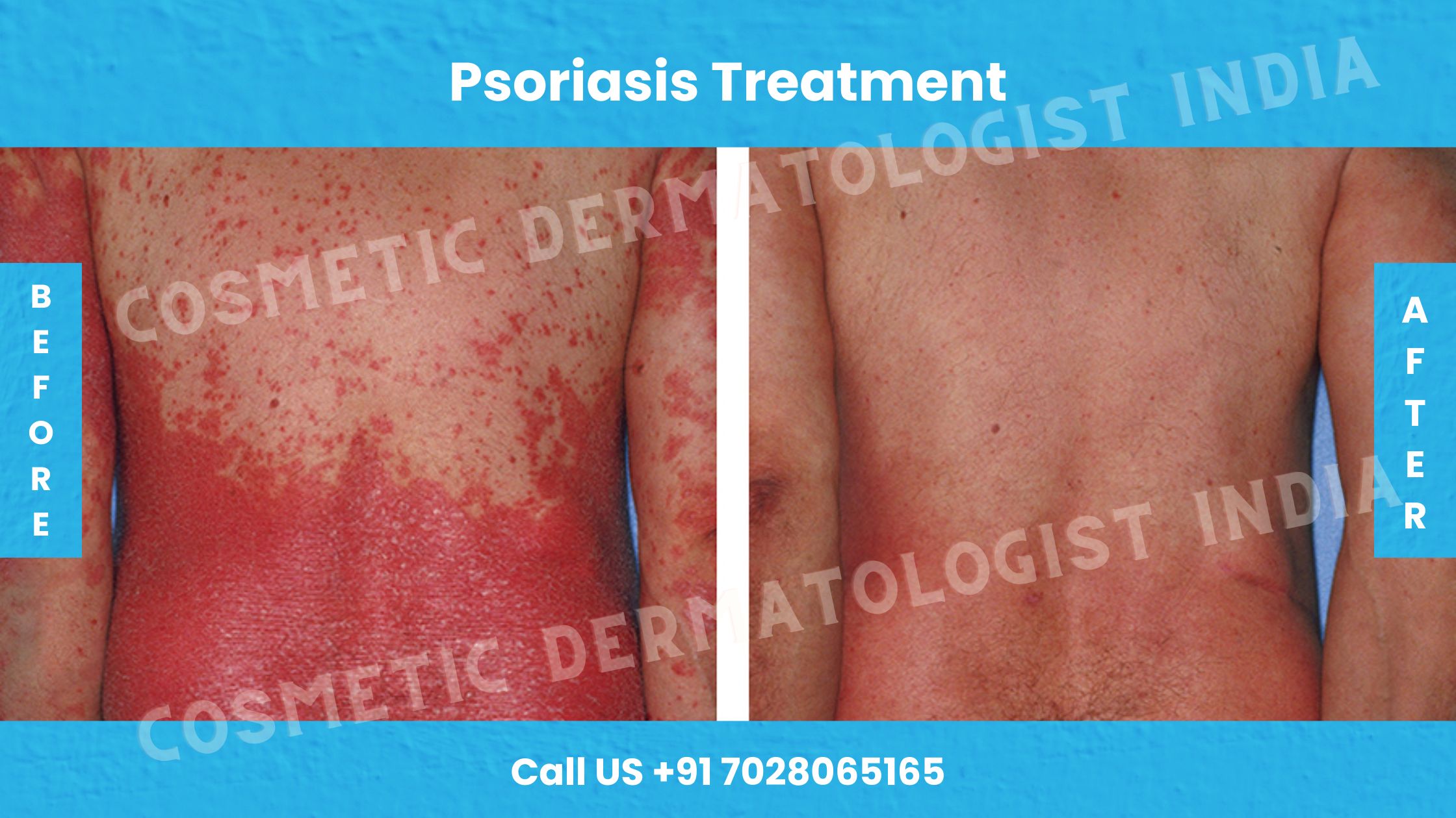 Before and After Photos For Psoriasis Treatment 