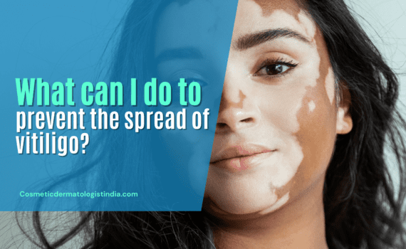 What can I do to prevent the spread of vitiligo?