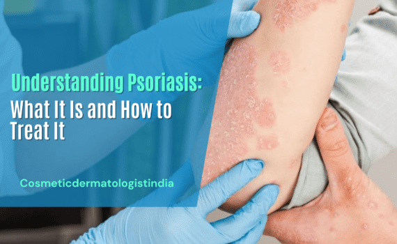 UNDERSTANDING PSORIASIS: WHAT IT IS AND HOW TO TREAT IT