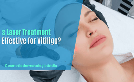 Is Laser Treatment Effective for Vitiligo?