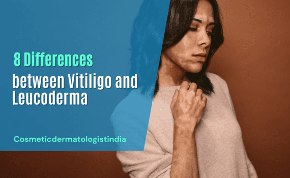 8 Differences between Vitiligo and Leucoderma