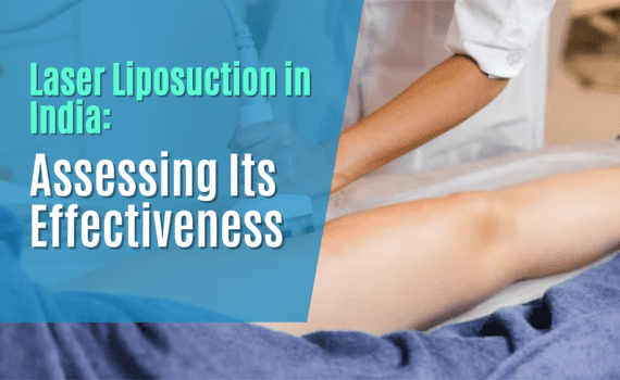 Laser Liposuction in India