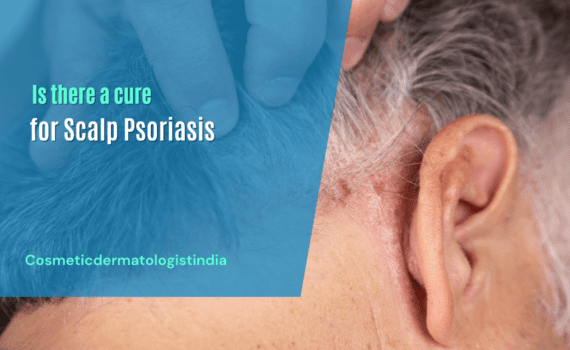 Scalp Psoriasis